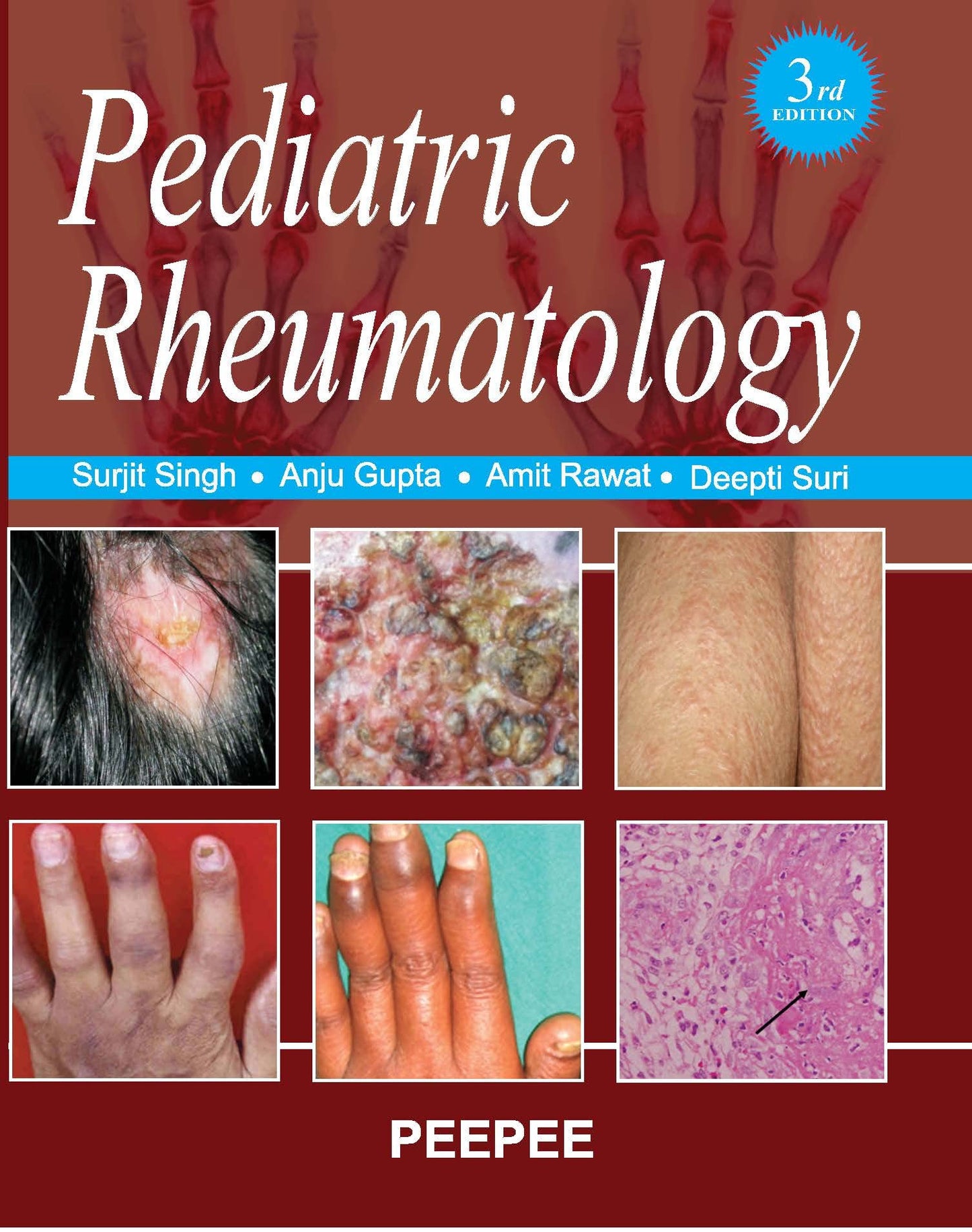 Pediatric Rheumatology-Singh