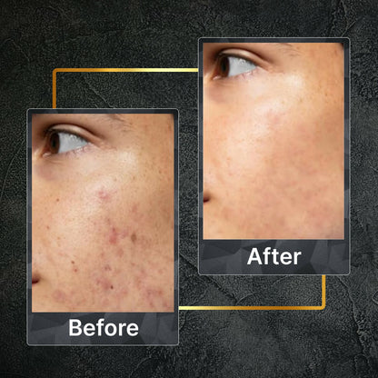 Tru Hair & Skin Nanotechnology Facewash For Sensitive-Acne Prone Skin