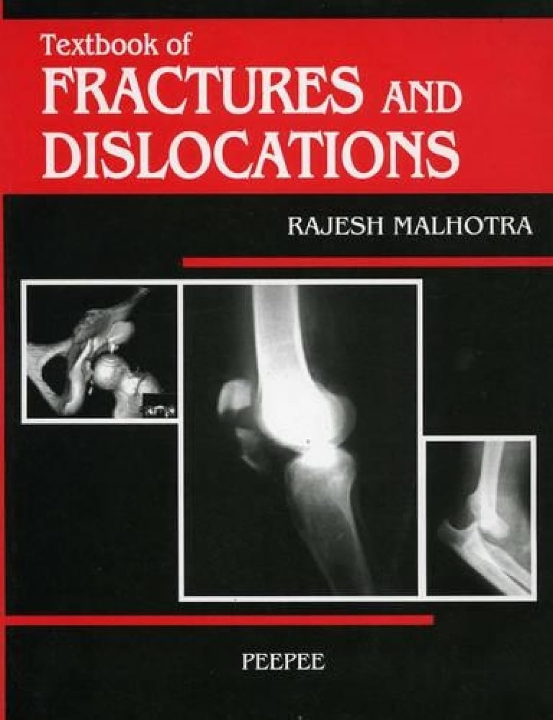 Textbook Of Fractures And Dislocations: Volume 1-Malhotra