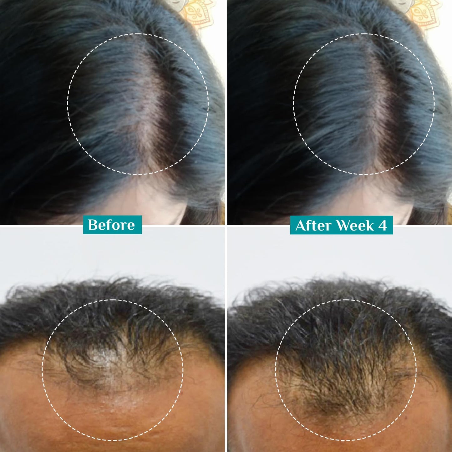 Redensyl 3% + Anagain 4% Hair Growth Serum 50ml for Scalp
