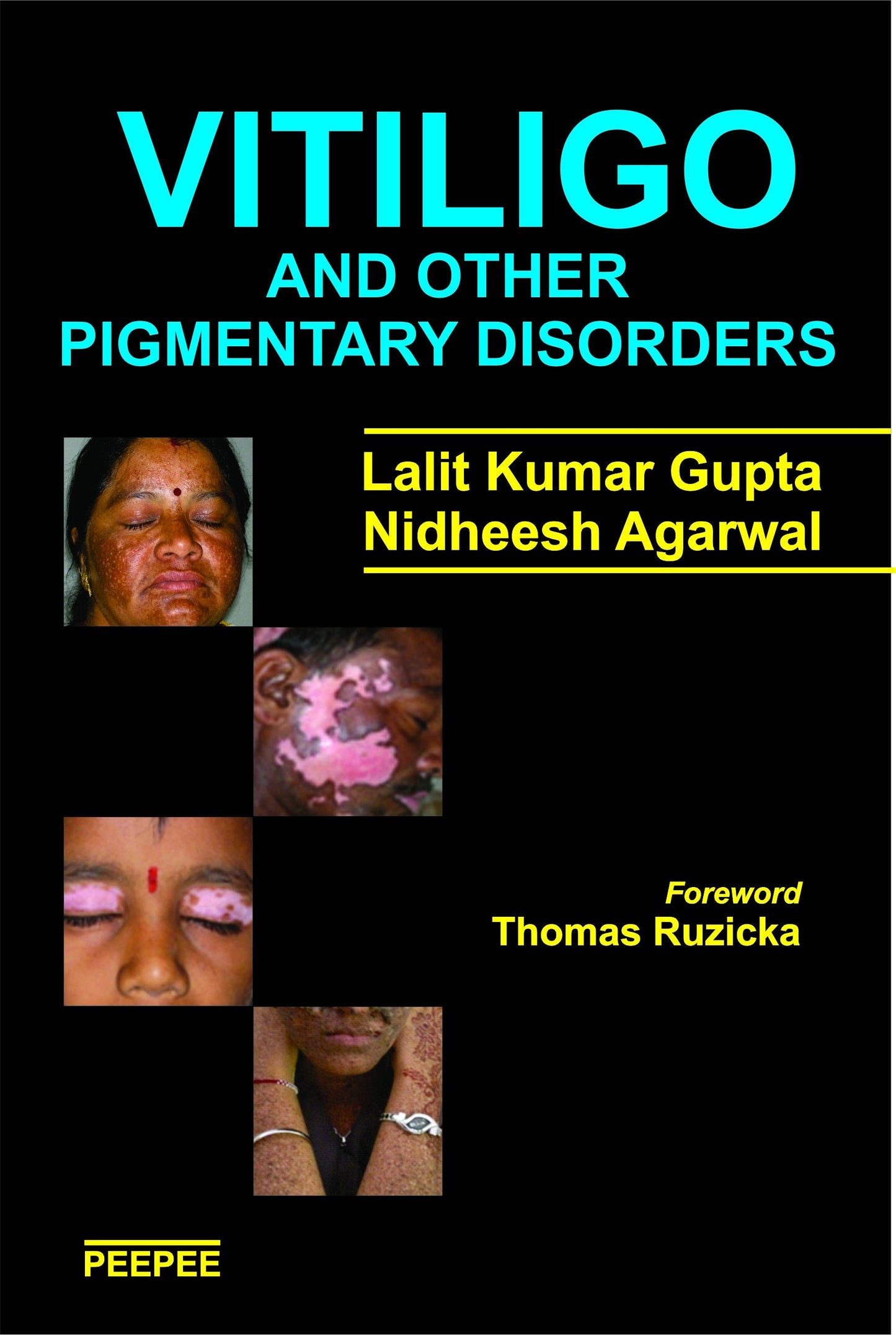 Vitiligo And Other Pigmentary Disorders-Lalit Gupta