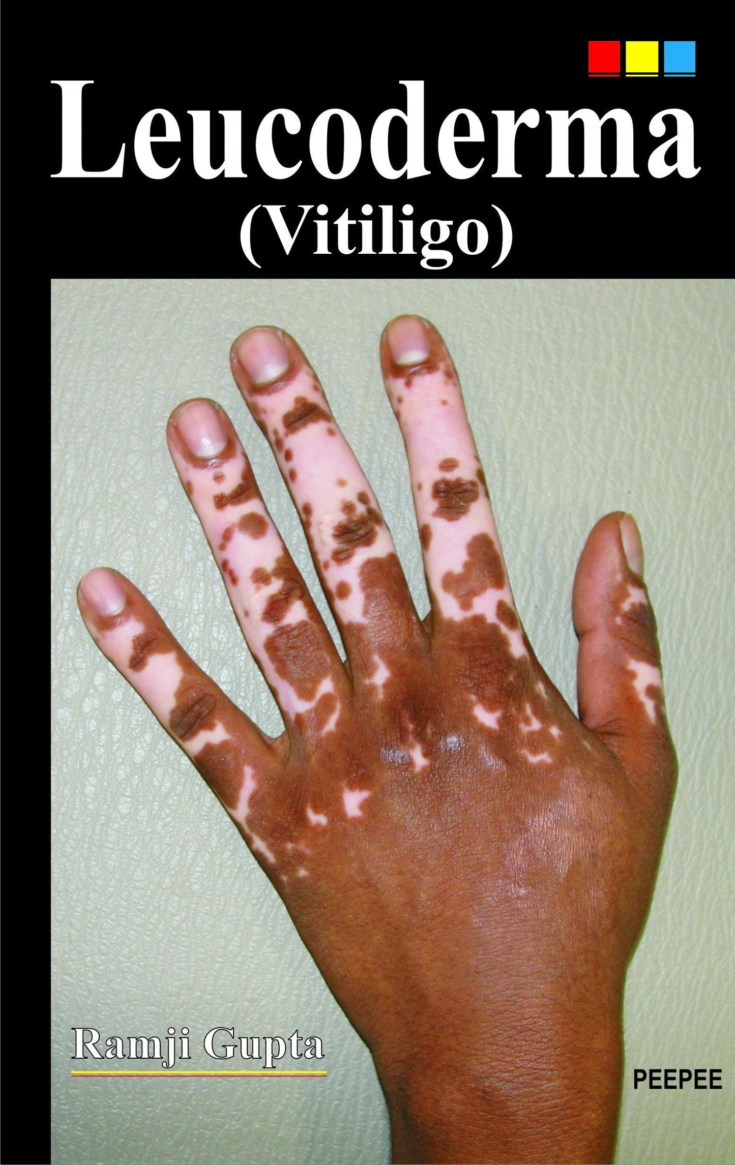 Leucoderma (Vitiligo)-Ramji Gupta