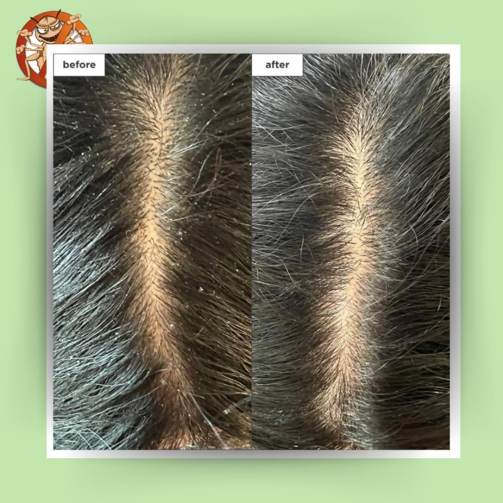 Botanical Luxuriate Tea Tree Natural Anti Lice and Nits Shampoo