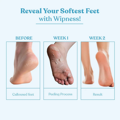 Wipness Natural Foot Peeling & Exfoliating Foot Mask