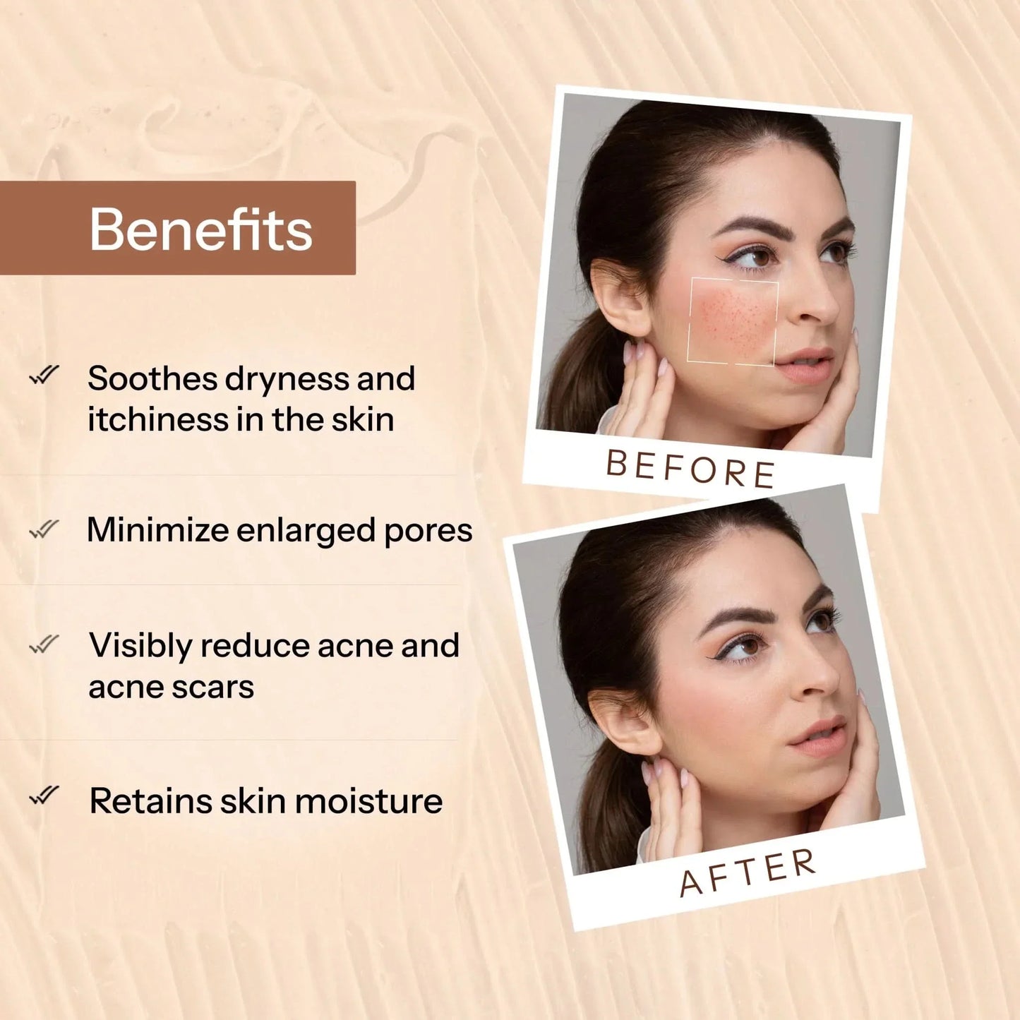 Glopetra Acne Scars & Pits Removal Gel