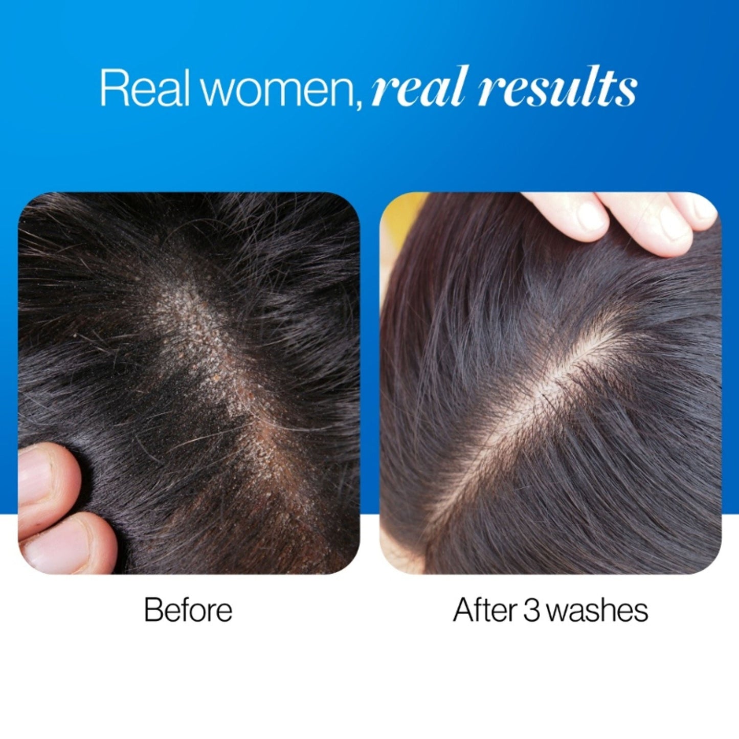 BeBodywise ZPTO Anti Dandruff Shampoo - Reduces Dandruff, Flaking & Deeply Hydrates Scalp